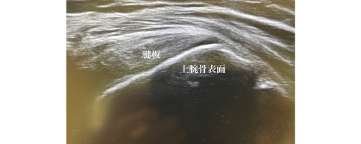 整形外科領域の超音波検査